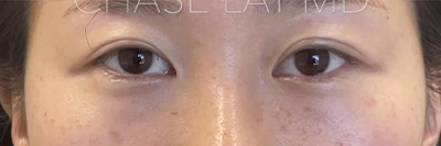 Asian Eyelid Surgery