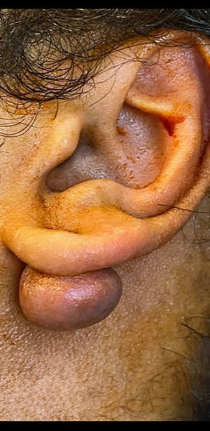 Keloid and Scar Revision