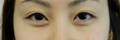 Asian Eyelid Surgery