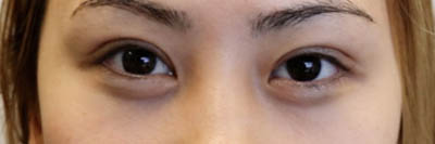 Asian Eyelid Surgery