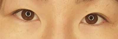 Asian Eyelid Surgery