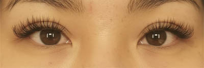 Asian Eyelid Surgery