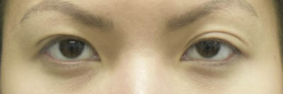 Asian Eyelid Surgery