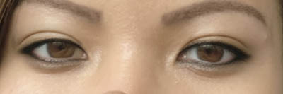 Asian Eyelid Surgery